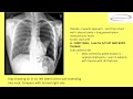 CHEST XRAY | INTERPRETATION | MADE EASY | MBBS | FINAL PRACTICAL EXAMS | RESIDENTS | PHYSICIANS