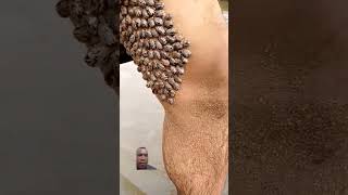 wash ticks on thighs jerawat blackhead blackheadremoval komedo acne blackheads komedohidung