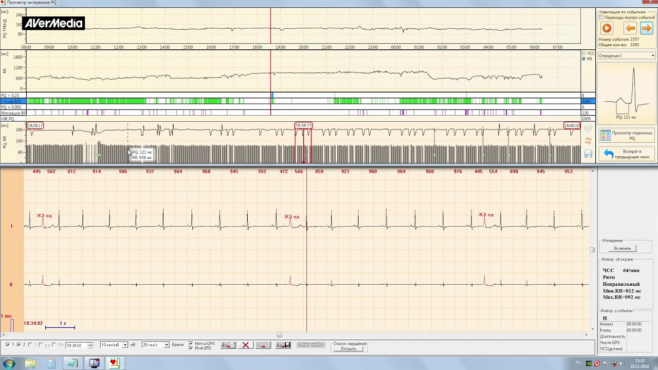 Обзор нарушений PQ и QT Видео №8 Холтер "КАРДИО-Астел" - YouTube