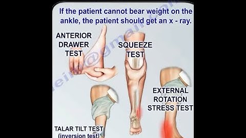 Ankle Ligament Injury, evaluation and tests. - Ankle ligament injury, diagnosis and treatment.