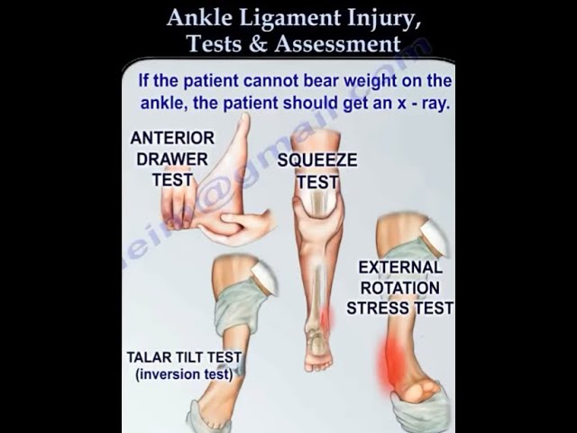 Ankle Ligament Injury, evaluation and tests. - Ankle ligament