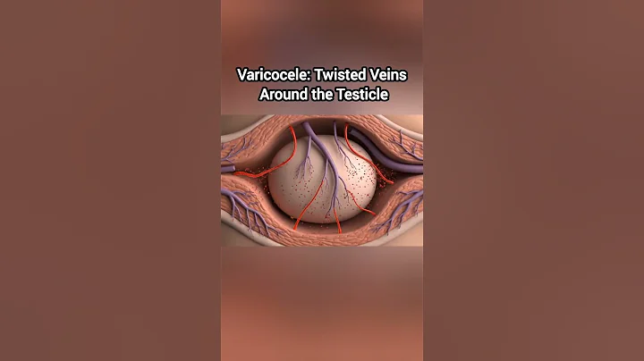 Varicocele: Twisted Veins Around the Testicle