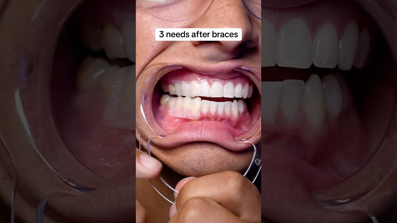 Get these after braces! 😬