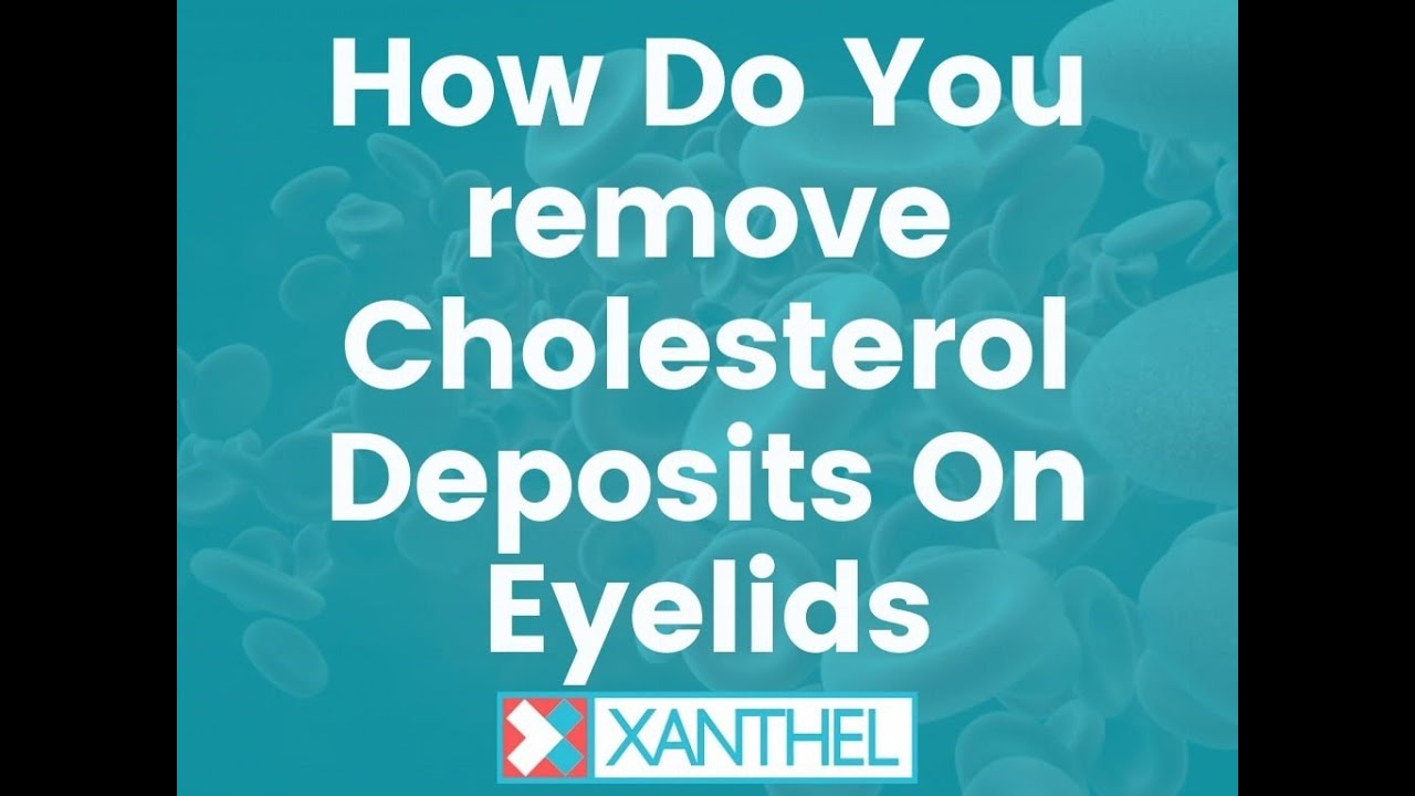 how-do-you-remove-cholesterol-deposits-on-eyelids-by-xanthel-easy
