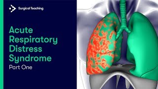 ARDS Part 1 | What is it and How Common is it?