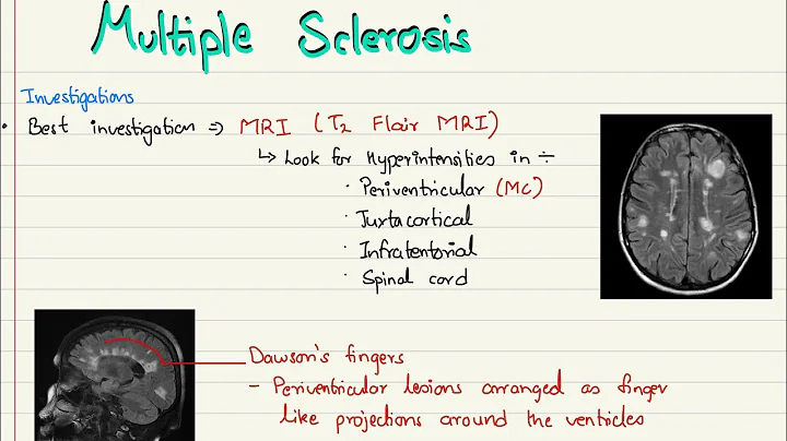 Multiple sclerosis: pathophysiology, classificatio...