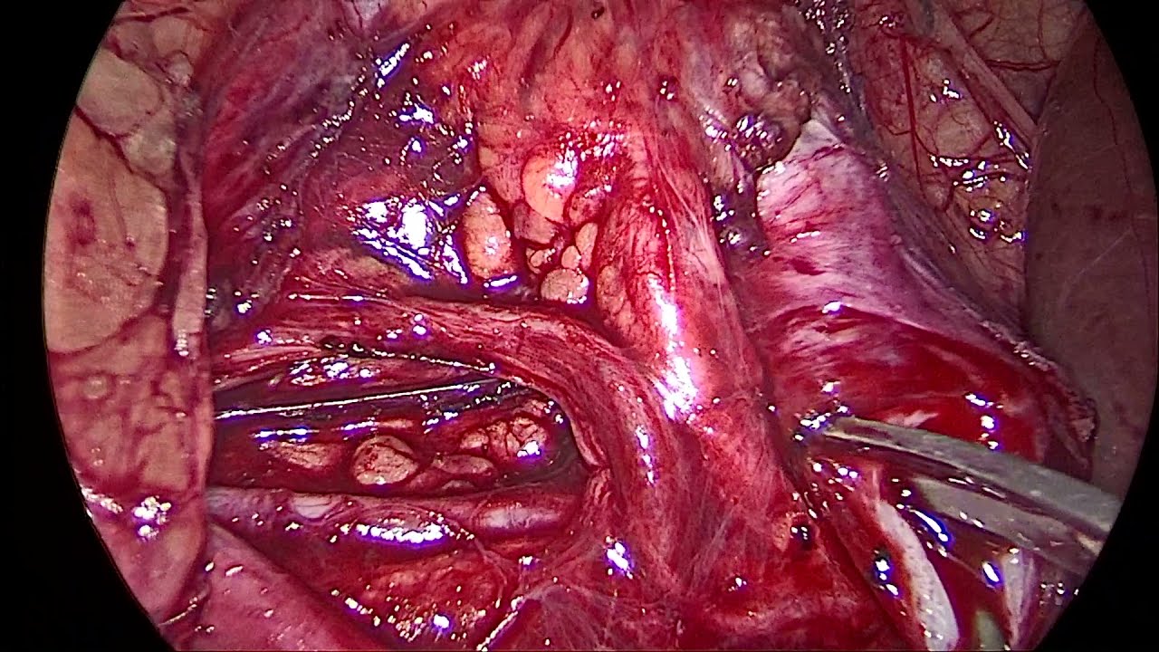 Laparoscopic Pyeloplasty in PUJ obstruction with Crossing vessel by Dr Adiitya Sharma