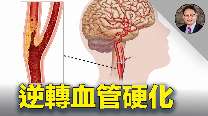 揭密逆转血管硬化的营养素组合！ 小心血管硬化这颗引爆重病的定时炸弹！ - 天天要闻