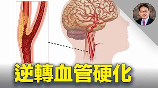 揭密逆轉血管硬化的營養素組合 小心血管硬化這顆引爆重病的定時炸彈