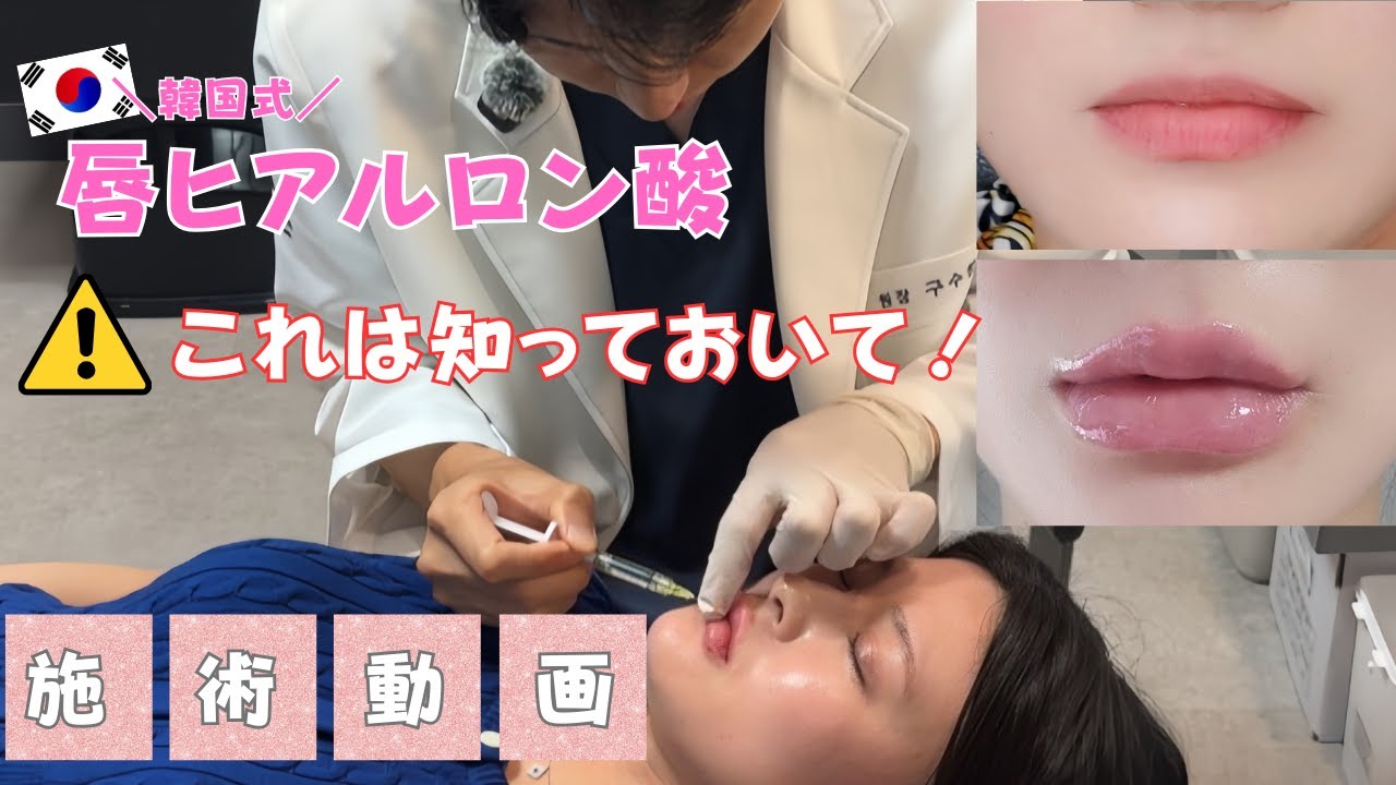 【唇ヒアルロン酸】失敗しないために知っておいてほしいこと