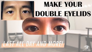 Treatable Cases 5 | Making double eyelids or fixing uneven eyelids with Optifold