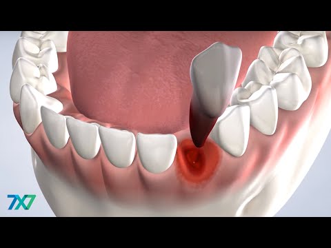 Tooth Extraction in San Francisco, CA | 7x7 Dental Implant & Oral Surgery Specialists