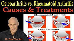 Osteoarthritis vs. Rheumatoid Arthritis (Causes & Remedies) - Dr. Alan Mandell D.C.