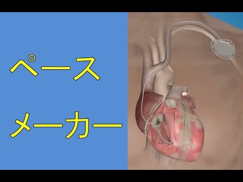 不整脈の治療　ペースメーカー