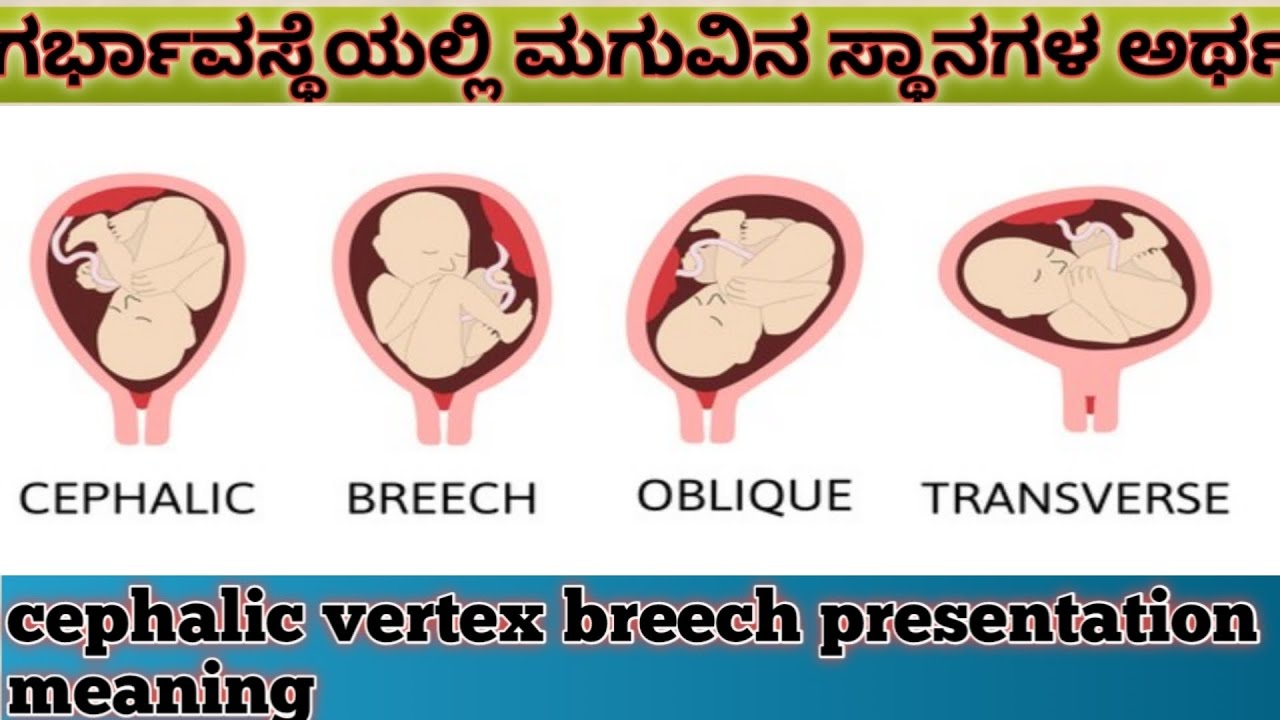 meaning of cephalic presentation in pregnancy in hindi