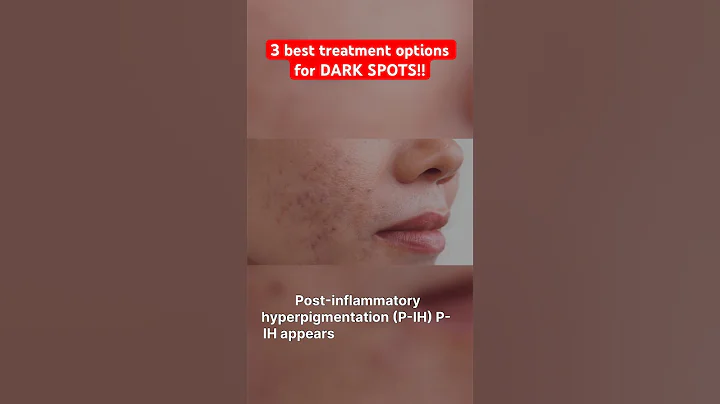 The Best Ingredients for Dark Spots (Hyperpigmentation) 👏🏻✨