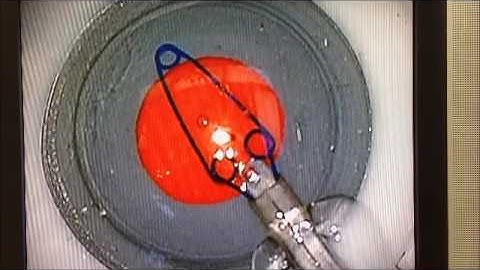 Malyugin Ring  Simul Eye