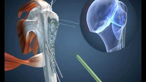 Proximal Humerus Features and Surgical Technique Animation