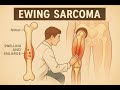 Ewing s Sarcoma