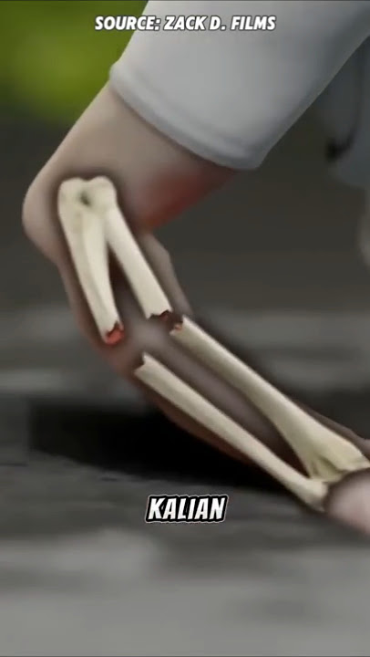 Don’t Ignore a Broken Bone! Here’s What Happens If You Avoid the Doctor