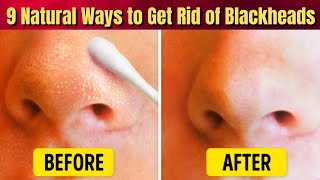 Banish Blackheads Naturally: 9 Effective Methods for a Clear Nose