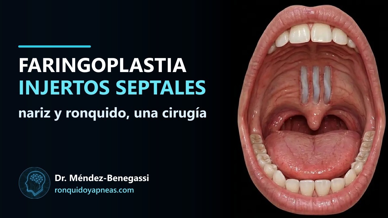 Faringoplastia con injertos septales, explicada por el Dr. Méndez-Benegassi