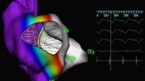 Atrial Flutter visualized by Non-Contact Mapping