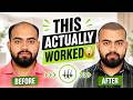 Hair Transplant in Delhi (HX-MQIN) | Best Results & Cost of Hair Transplant in Delhi