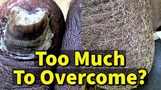 Too Much To Overcome?: Severe Fungal Toenails and Athlete's Feet