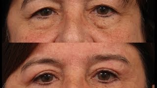 Female Upper & Lower Eyelid Blepharoplasty by Dr. Edwin Williams