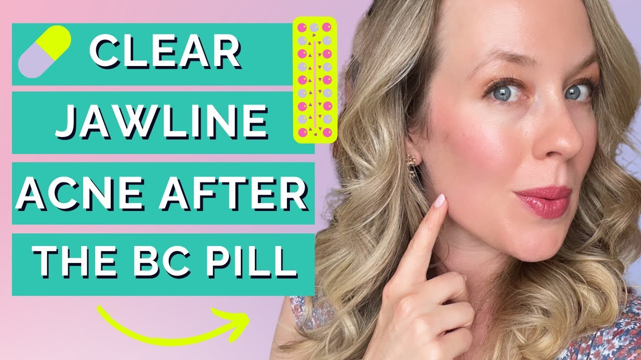Jawline acne after stopping birth control CAUSES & ACTION STEPS YouTube