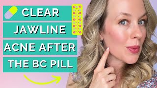 Jawline acne after stopping birth control - CAUSES & ACTION STEPS