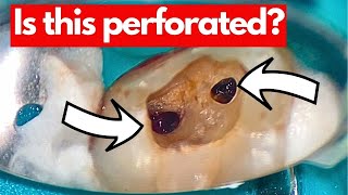 How to UNROOF a Maxillary Molar Predictably.