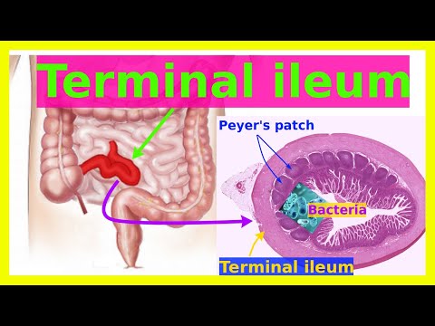 Video: I terminal ileum?