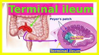 terminal ileum