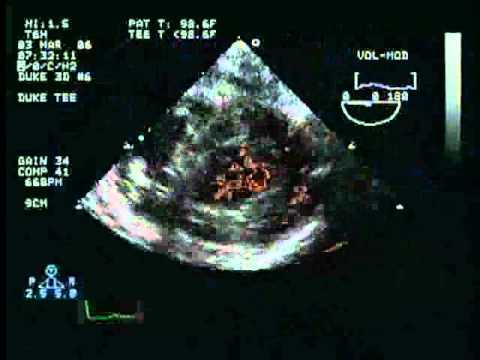 LV Systolic Function Assessment: Examination of regional wall motion ...