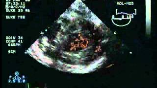 LV Systolic Function Assessment: Examination of regional wall motion