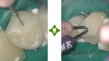 Micro-Invasive Endodontic Treatment - SICAT ENDO - Dr. Tomas Lang