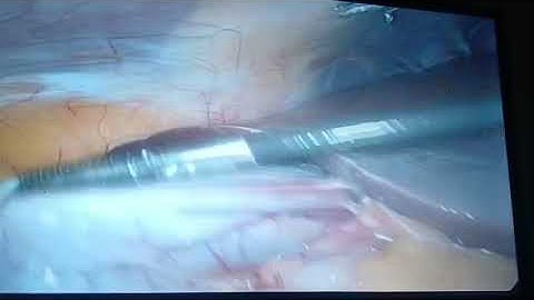 Floating/Mesentric Gall bladder 