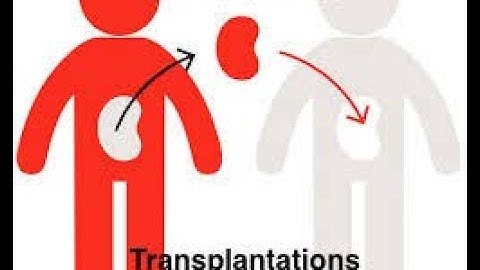 Transplantation Procedures ICD-10-CM/PCS