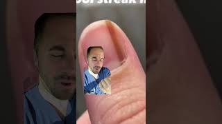 Subungual melanoma in the nail  !? Doctor reacts #striate melanonychia #subungualmelanoma