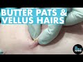 Dr Pimple Popper Mines For Butter Pats & Eruptive Vellus Hairs