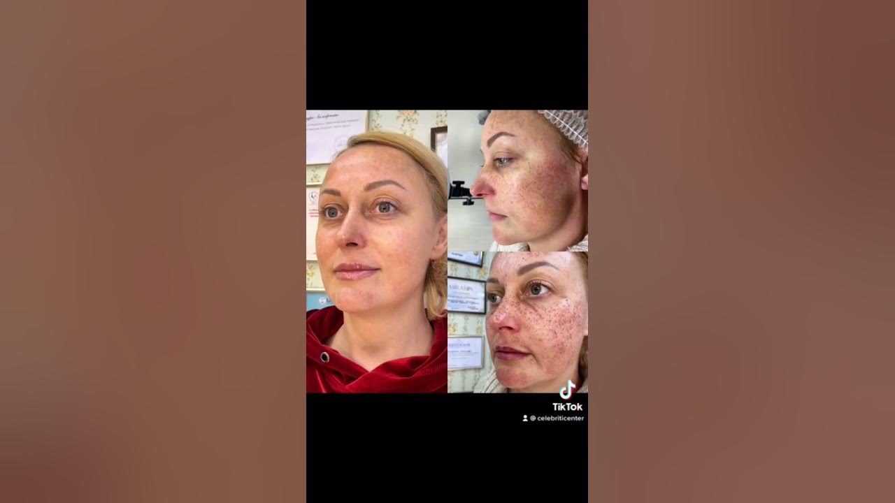 Фотоомолодження IPL Lumenis m22 , лікування пігментаціі, судин ...