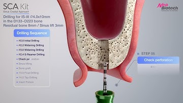 SCA Kit｜Sinus lift   Crestal approach with bone graft｜Procedure Neobiotech