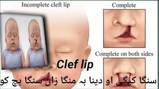 Cleft Lip | Definition | Types | Sign Symptoms | Diagnosis | Complications | Treatment