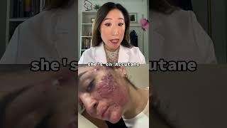#accutane can be transformative for the right patient! vid cred daisyycbj