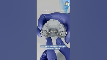 HOW TO: Palatal Expander | Step-by-Step Turning Instructions