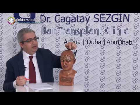 Saç ekiminde kaç