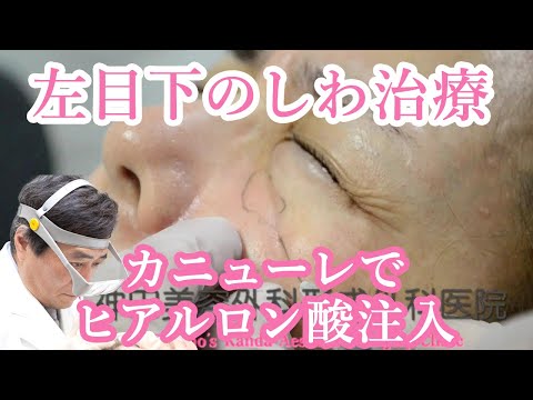 左下眼瞼の陥凹にカニューレでヒアルロン酸注入治療