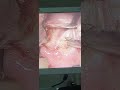 Tonsillectomy with vessel sealer / કાકડા નું ઓપરેશન કઈ રીતે થાય જુઓ આ વિડીયો